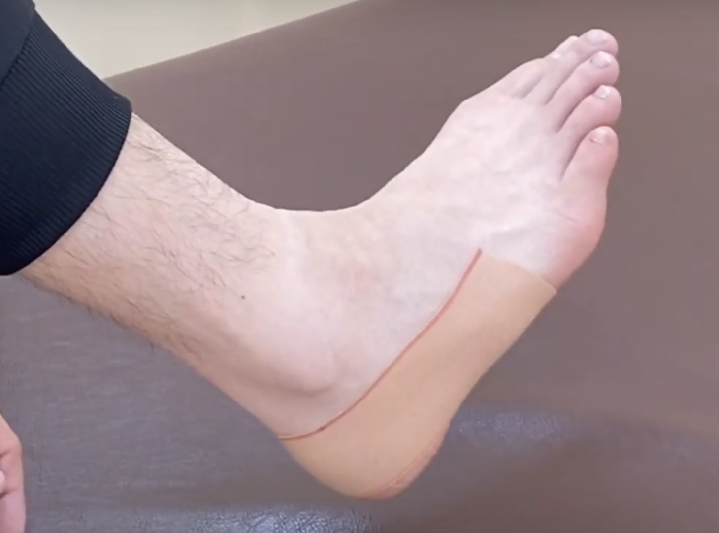 モートン病の足裏の痛みを改善する簡単テーピング