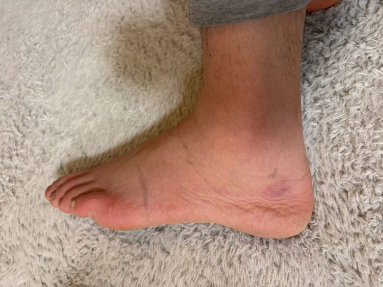 捻挫した左の足首。くるぶしの下に紫色の内出血が出ていて、周りが腫れている