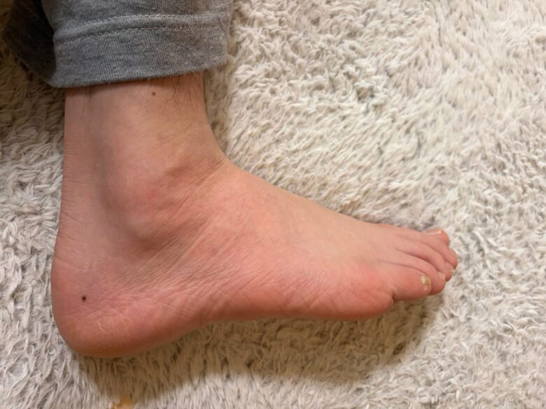 痛めていない右の足首。腫れも内出血もない状態